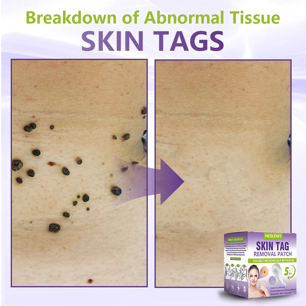 Soluble Microneedle Botanical Skin Tag Removal Patch
