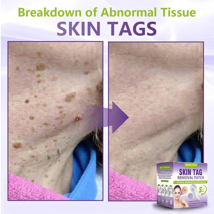 Soluble Microneedle Botanical Skin Tag Removal Patch