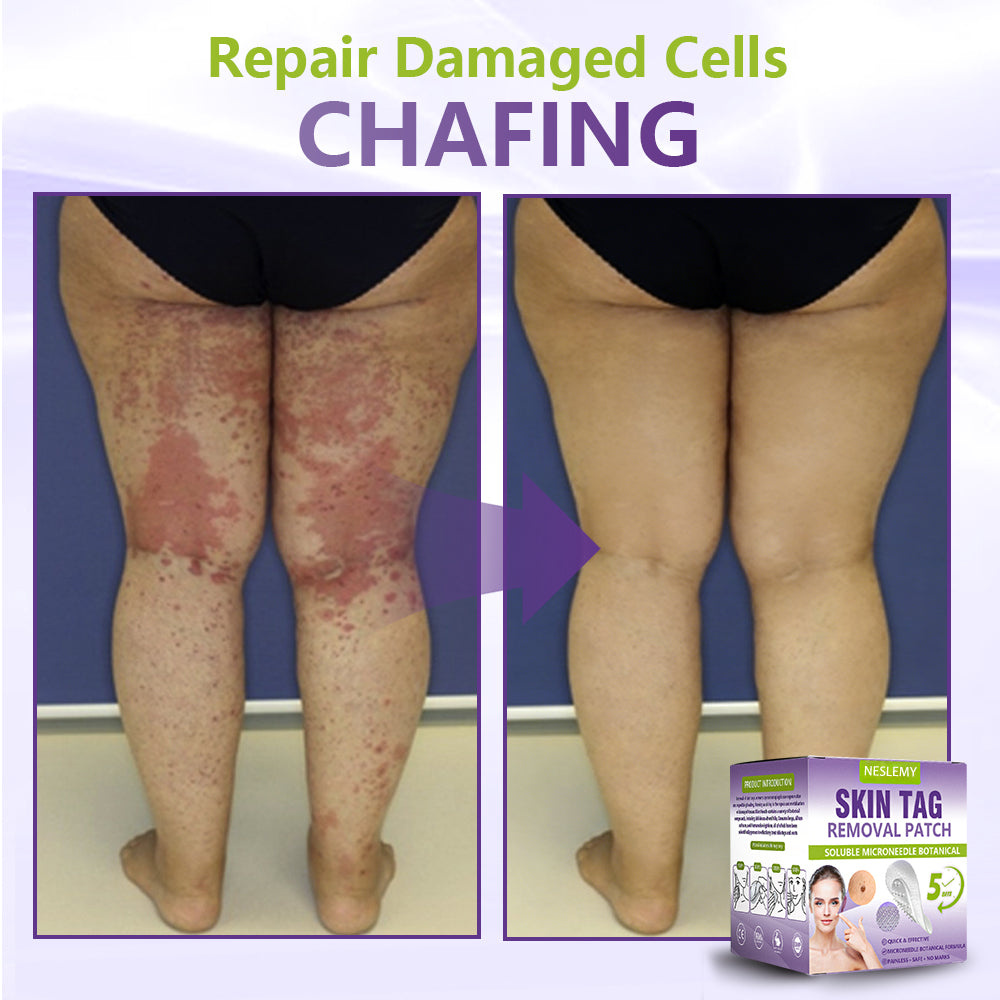 Soluble Microneedle Botanical Skin Tag Removal Patch