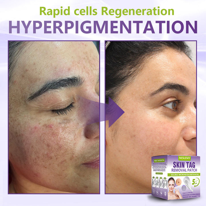 Soluble Microneedle Botanical Skin Tag Removal Patch