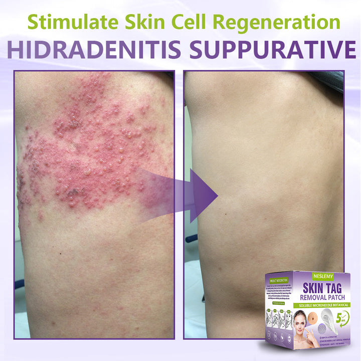 Soluble Microneedle Botanical Skin Tag Removal Patch