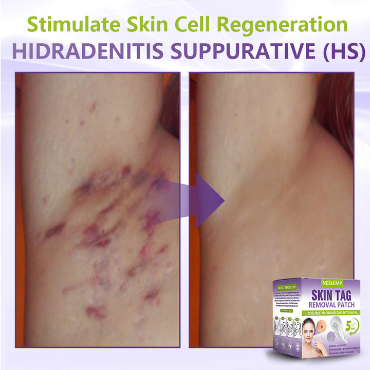 Soluble Microneedle Botanical Skin Tag Removal Patch