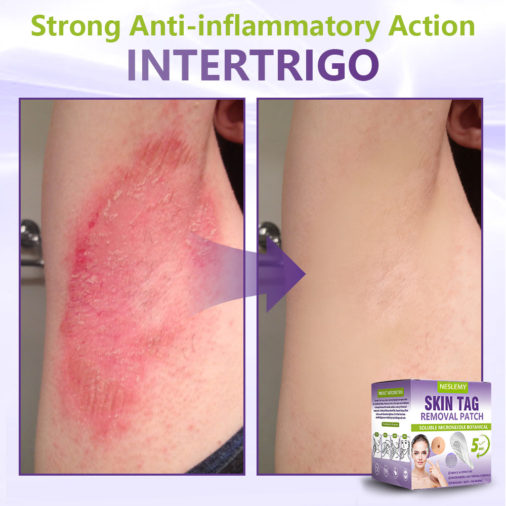 Soluble Microneedle Botanical Skin Tag Removal Patch