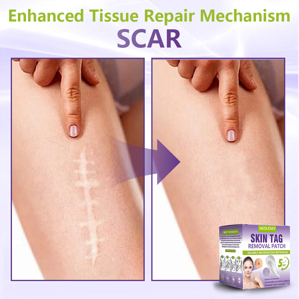Soluble Microneedle Botanical Skin Tag Removal Patch
